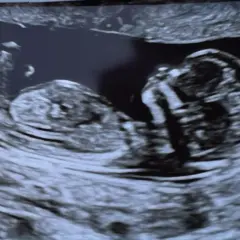 USG płodu, widać główkę i tułów. To zdjęcie z okresu, w ktorym tygodniu widac plec.