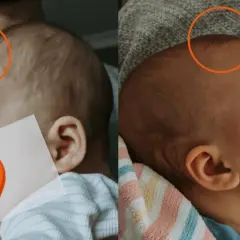 Dwa ujęcia główki niemowlaka. Na pierwszym widać wyraźne ciemiączko, na drugim jest ono mniej widoczne.