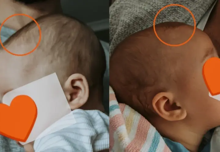 Dwa ujęcia główki niemowlaka. Na pierwszym widać wyraźne ciemiączko, na drugim jest ono mniej widoczne.