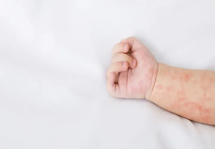 Ręka niemowlaka z zaczerwienioną wysypką. Skóra pokryta jest drobnymi, różowymi plamkami, które mogą świadczyć o alergii lub chorobie.