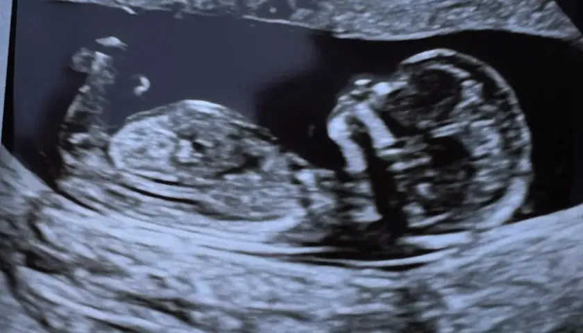USG płodu, widać główkę i tułów. To zdjęcie z okresu, w ktorym tygodniu widac plec.