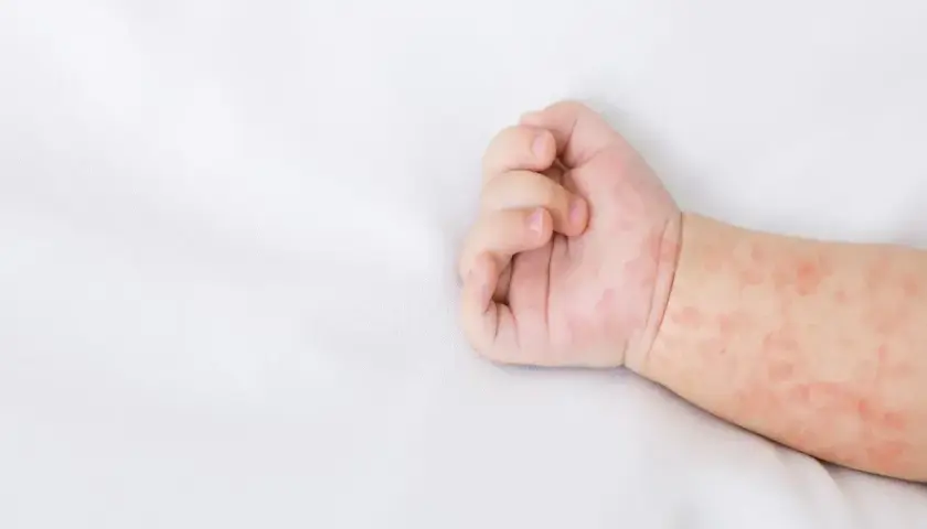 Ręka niemowlaka z zaczerwienioną wysypką. Skóra pokryta jest drobnymi, różowymi plamkami, które mogą świadczyć o alergii lub chorobie.