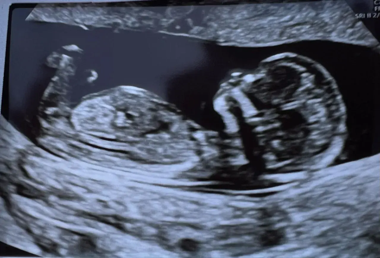 USG płodu, widać główkę i tułów. To zdjęcie z okresu, w ktorym tygodniu widac plec.