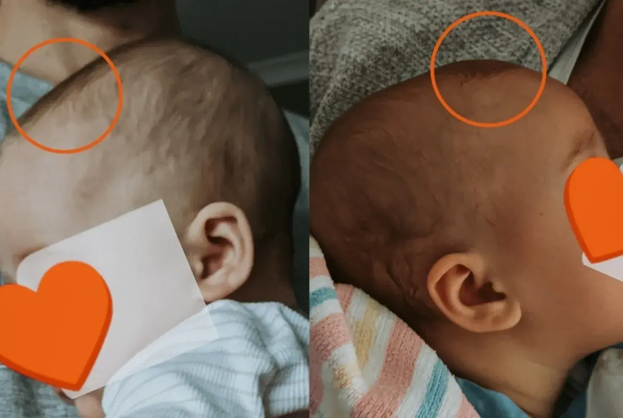 Dwa ujęcia główki niemowlaka. Na pierwszym widać wyraźne ciemiączko, na drugim jest ono mniej widoczne.