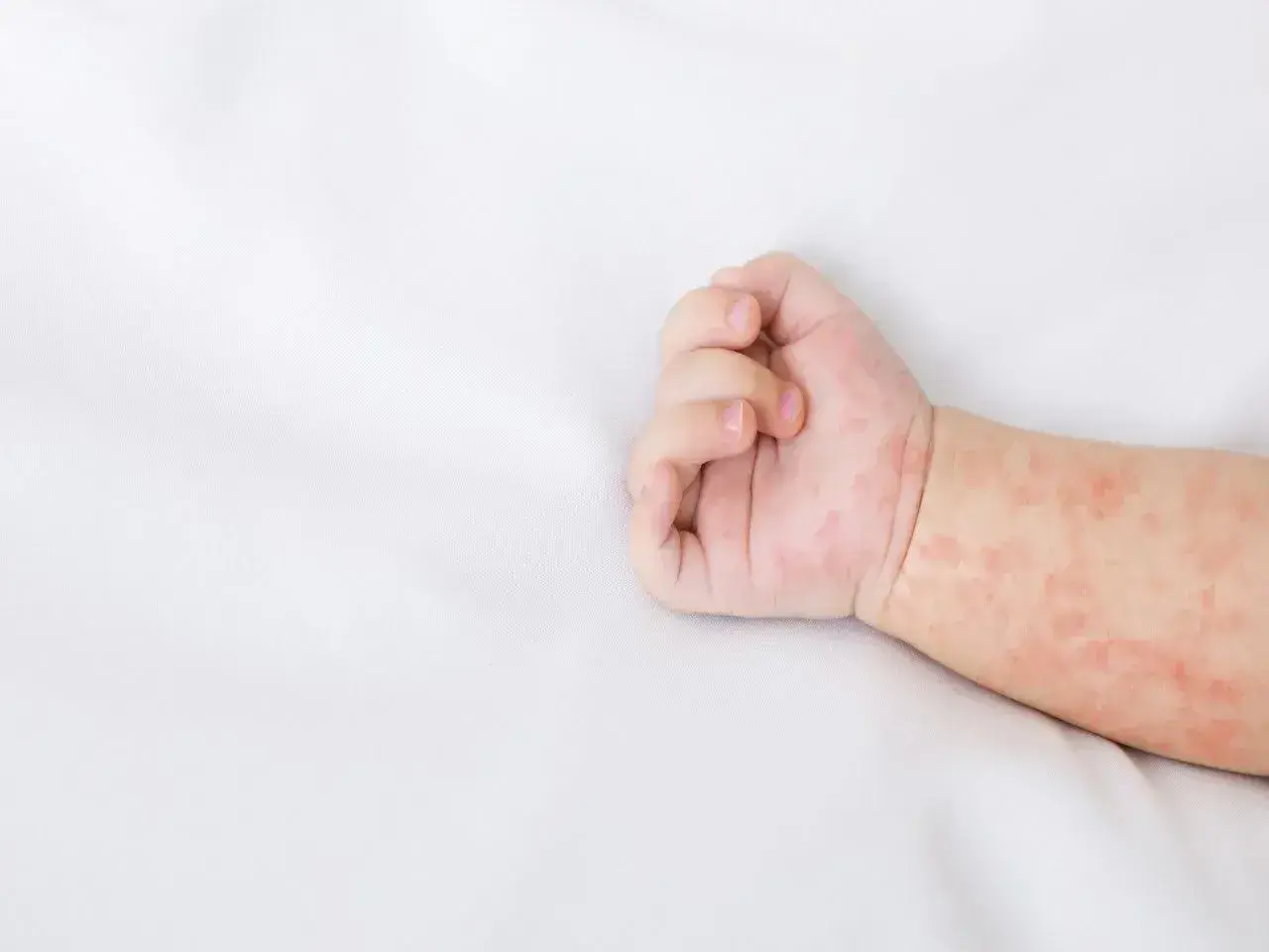 Ręka niemowlaka z zaczerwienioną wysypką. Skóra pokryta jest drobnymi, różowymi plamkami, które mogą świadczyć o alergii lub chorobie.