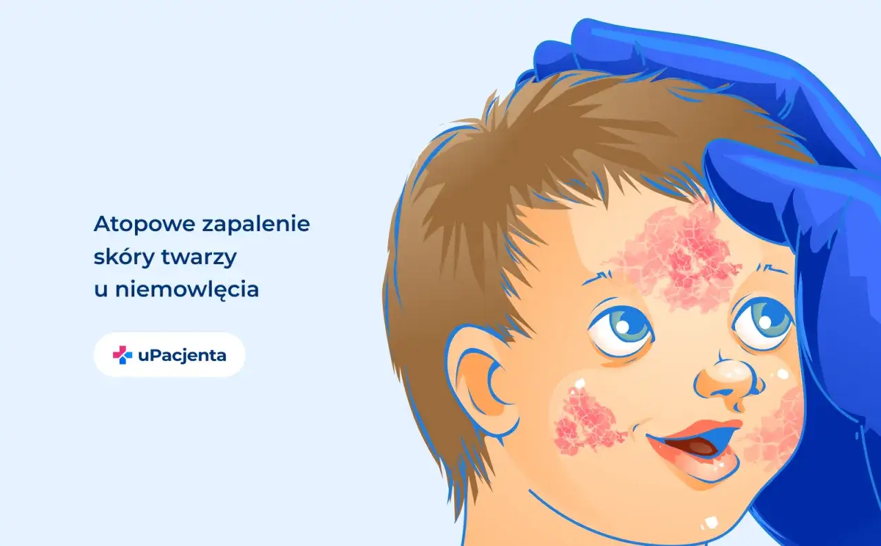 Dłoń w niebieskiej rękawiczce delikatnie dotyka czoła dziecka z objawami atopowego zapalenia skóry.